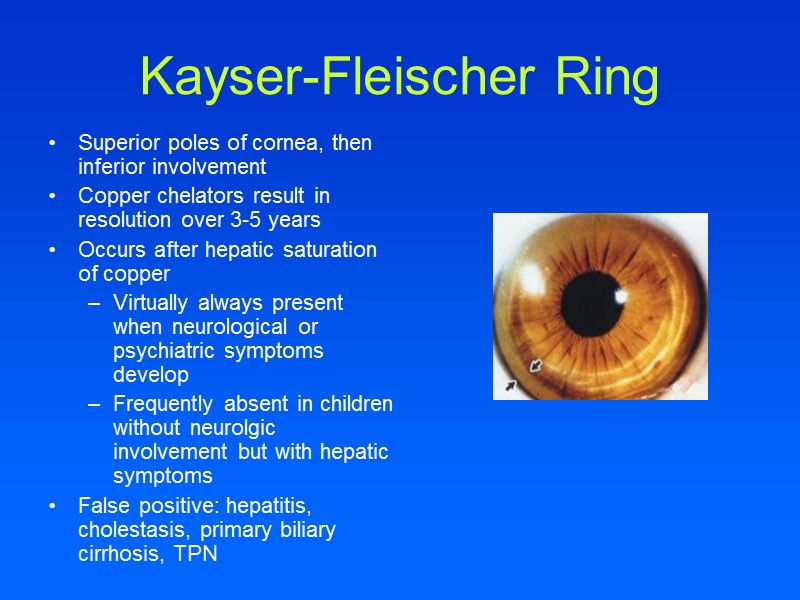 Kayser-Fleischer Ring Superior poles of cornea, then inferior involvement  Copper chelators result in